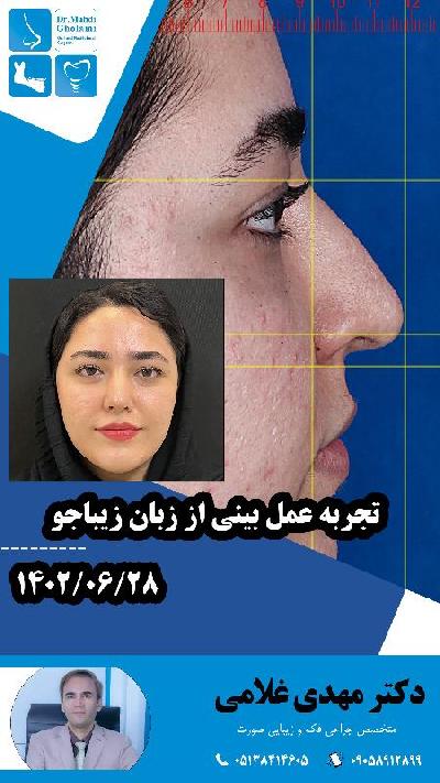تجربه جراحي بيني با زيباجو دکتر مهدي غلامي در مشهد