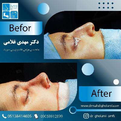 قبل و بعد از جراحي بيني با دکتر مهدي غلامي در مشهد