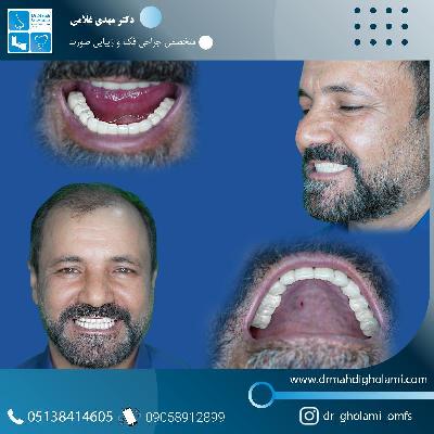 ايمپلنت تمامي دندان ها توسط دکتر مهدي غلامي بعد از 4 سال