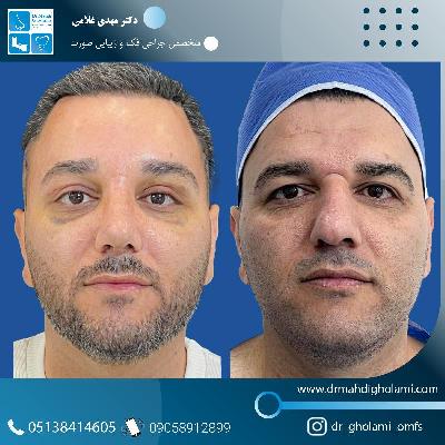 جراحي بيني با دکتر مهدي غلامي در مشهد