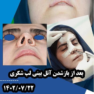 بعد از باز شدن آتل بيني بيمار لب شکري توسط دکتر مهدي غلامي