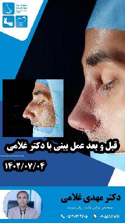 قبل و بعد از عمل بيني با دکتر مهدي غلامي در مشهد
