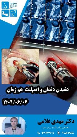 کشيدن دندان و ايمپلنت همزمان با دکتر مهدي غلامي در مشهد