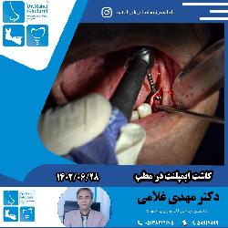 کاشت ايمپلنت در مطب دکتر مهدي غلامي در مشهد