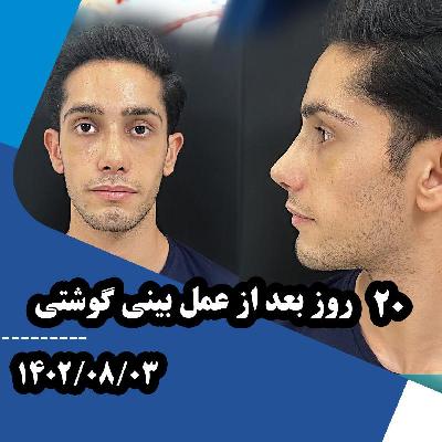 20 روز بعد از عمل بيني گوشتي توسط دکتر مهدي غلامي در مشهد