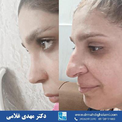 جراحي بيني با دکتر مهدي غلامي در مشهد