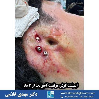 ايمپلنت گوش توسط دکتر مهدي غلامي در مشهد