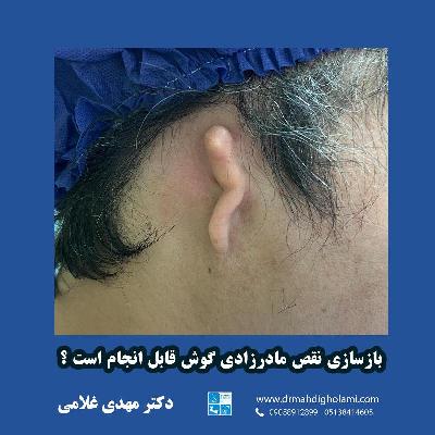بازسازي نقص مادرزادي گوش با دکتر مهدي غلامي در مشهد