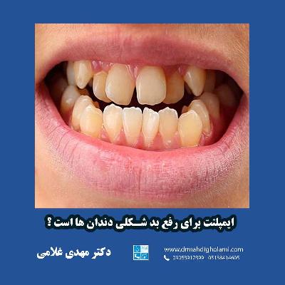 ايمپلنت براي رفع بدشکلي دندان ها است؟