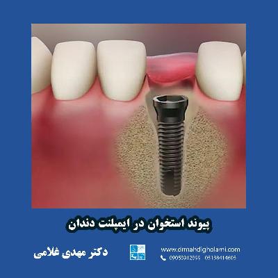 پيوند استخوان در ايمپلنت دندان