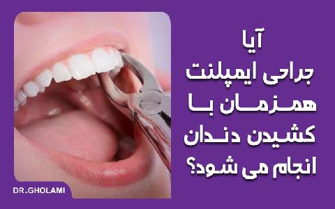 آيا جراحي ايمپلنت همزمان با کشيدن دندان انجام مي شود؟
