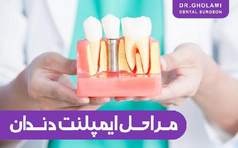 مراحل ايمپلنت دندان