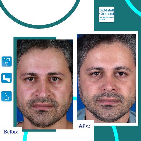 تصاویر قبل و بعد از عمل